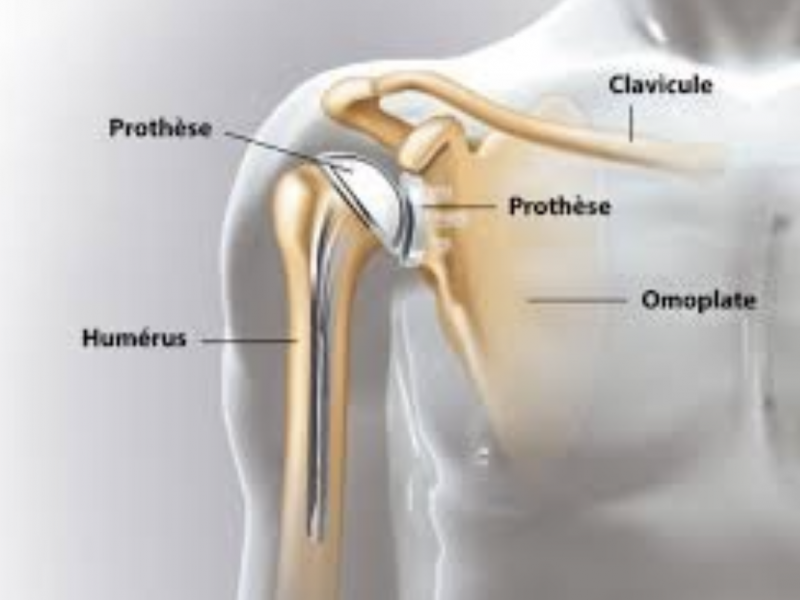 prothèse épaule centre de consultation guadeloupe
