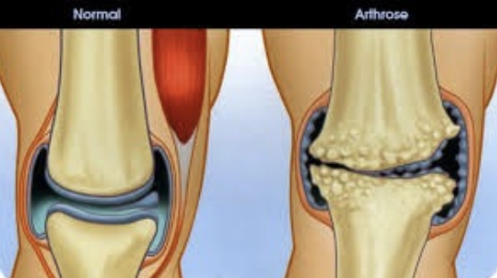 arthrose centre de consultation guadeloupe